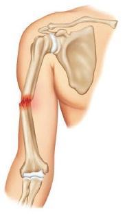 what kind of bone fracture is this