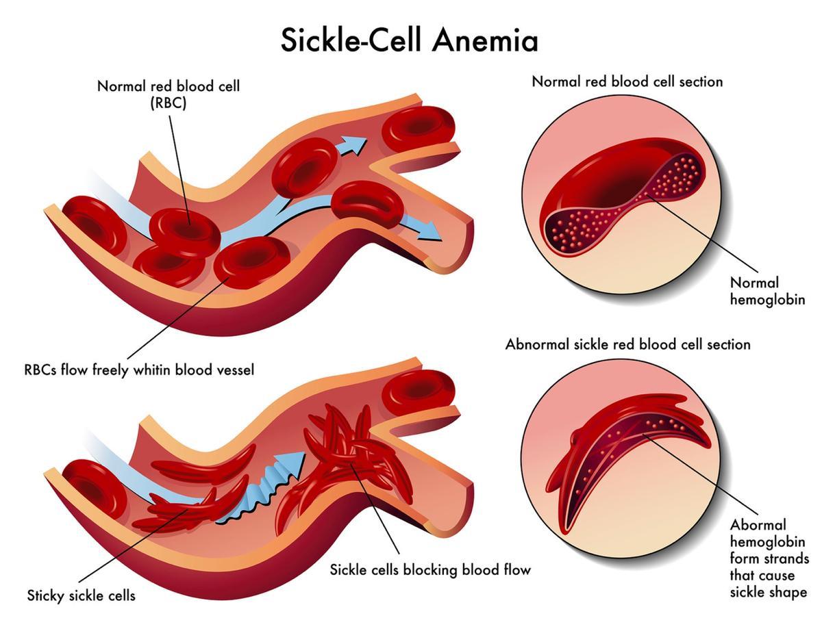 Whih Type Of Blood Cell Does Sickle Cell Anaemia Affect?